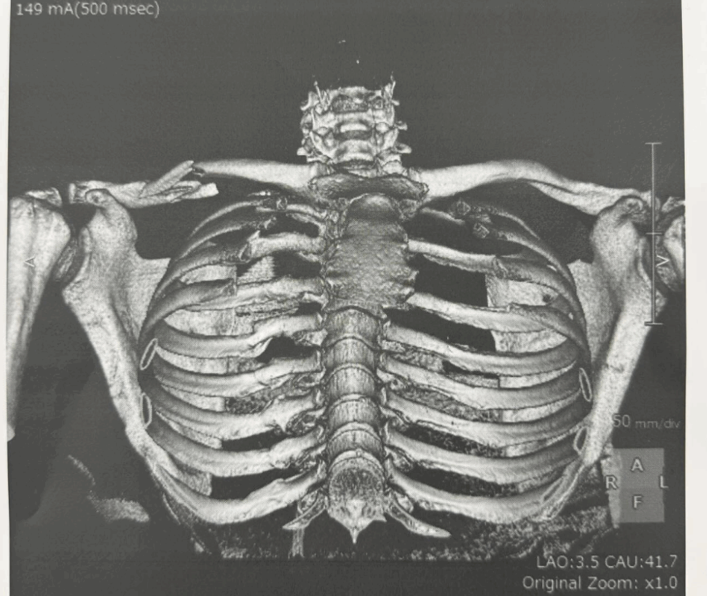 BREAKING – Jorge Martin undergoes surgery after collarbone injury: will miss the Indonesian GP